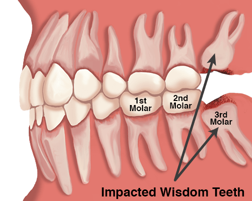 Wisdom-Teeth